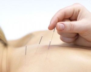 acupuntura-4